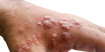 Skin infected Herpes zoster virus on the arms